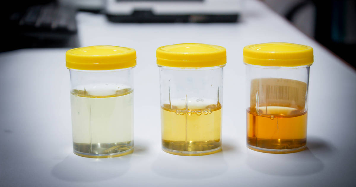 Dark urine and other colors in urine: meaning and causes